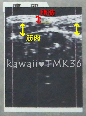 腹部の超音波画像